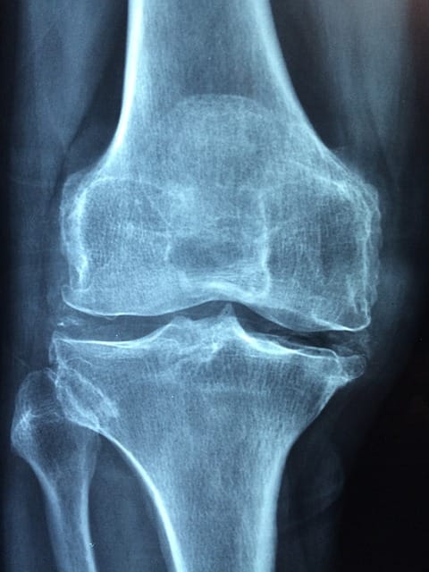 knee arthritis pain